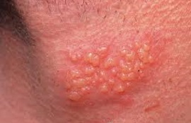 herpes simplex typ 2